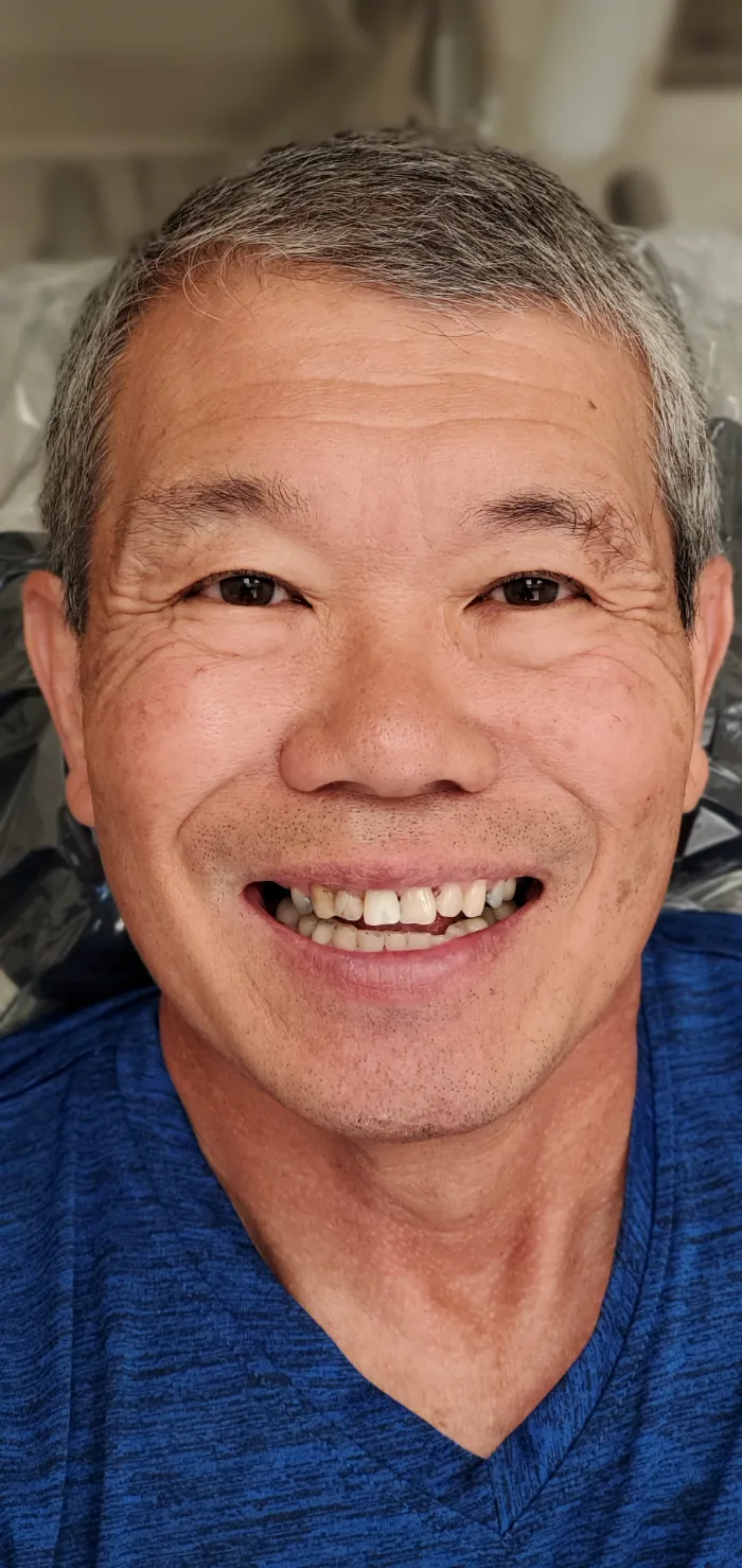 Before and after dental result